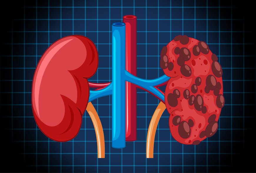 Ayurvedic Treatment for Kidney Disease | Karma Ayurveda